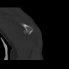 SPORK, NICO - 22.03.1976 - 02.08.2022 - CT obere Extremität - 18:01:46